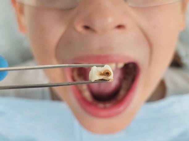 Best Root Canal Emergency Dentist  in Belmont, MS